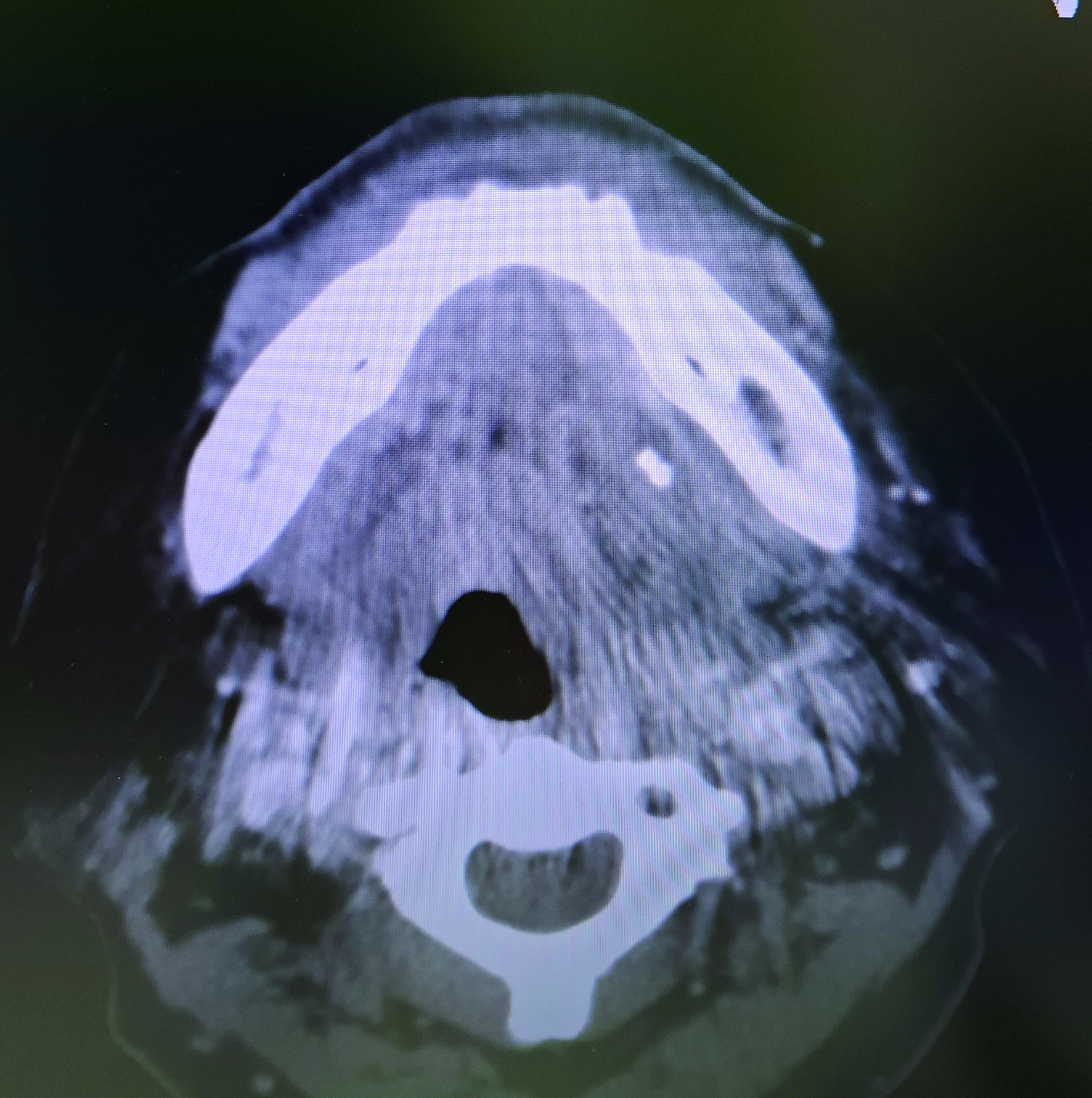 下頷腺導管結石